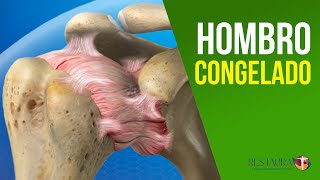 Hombro congelado  Capsulitis adhesiva del hombro  Causas y tratamiento [upl. by Solohcin]