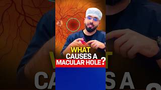 What causes a Macular Hole [upl. by Greenleaf]