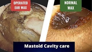 Mastoid cavity issues Purpose Problems Discharge Deafness Dizziness Dependence [upl. by Metcalf644]