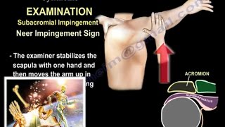 Shoulder Impingement Syndrome  Everything You Need To Know  Dr Nabil Ebraheim [upl. by Eram]