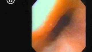 TOP 14 Part 1 Flexible Endoscopy [upl. by Naujat]