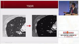 Treatment Strategy for Ground Glass Opacity and Tiny Lung Nodules [upl. by Eclud]