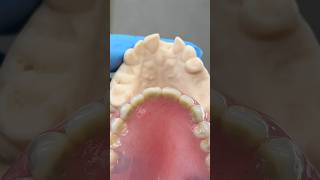 Before and After Immediate Denture ​⁠EnvisiontecMain envisiontec lsk121shorts dentist teeth [upl. by Tallu396]