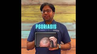 psoriasis skincare biologics dermatologisthyderabad subscribe viralvideo india beauty short [upl. by Ayikan]