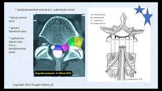 3 Key Ligaments of the Lumbar Spine and Their Related Pathology Disc Herniation Stenosis amp DISH [upl. by Etnovad]