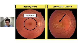 New treatments for wet AMD Nigel Davies [upl. by Soren]