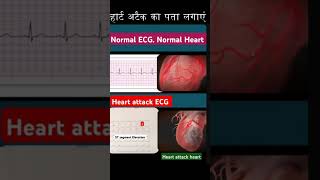 Normal ECG vs Heart Attack ECGshorts [upl. by Nahsab]