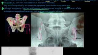 96P Introduction to the Seronegative Spondyloarthropathies [upl. by Noel]