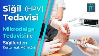 Siğil Tedavisi HPV Tedavisi Siğil Kökü Nasıl Çıkarılır I TuranampTuran [upl. by Nedah]