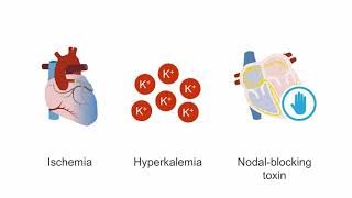 Managing cardiogenic shock [upl. by Hayidah]