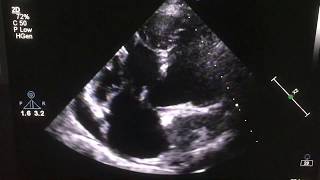 Large VSD with PDA PFO and tortuous aorta Echocardiography [upl. by Lough]