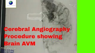 Cerebral Angiography Procedure showing Brain AVM [upl. by Eiramyelhsa73]