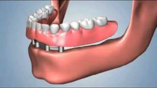 edentulismo completo opciones fija total sobredentaduraflv [upl. by Vary]