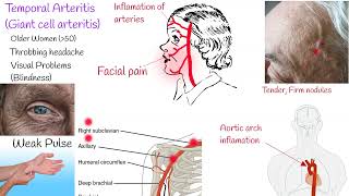 Temporal Arteritis Giant Cell arteritis Symptoms and treatment [upl. by Rodrich]