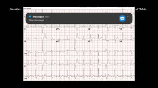 Heart skips a beat Anxiety and pvcs [upl. by Ciredor]