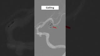 MCA Bifurcation Aneurysm Coiling coiling interventional cerebralangiography [upl. by Akenom]