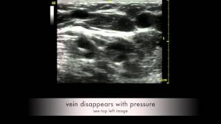 discrimination between vein and artery [upl. by Fosdick]