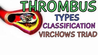 What is a Thrombus Types  Classification  Virchows Triad [upl. by Pages412]