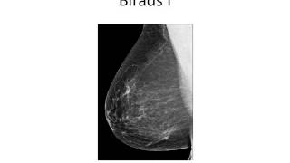 3 Mamografía BIRADS y conducta médica [upl. by Apollo]