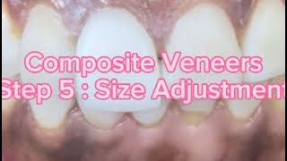 Composite Veneers Step 5 Size Adjustment [upl. by Willamina]