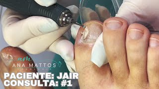 Coleta de Fungo  Laser Terapia  Aplicação de Ácido  Paciente Jair Consulta 1 [upl. by Allicserp98]