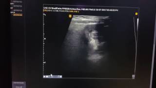 Intussusception Sonography Short Clip [upl. by Holland]