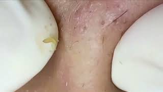 Blackheads amp Whiteheads Removal On Girls Chin 2024 Acne Treatment With Nhat Bang Channel acne [upl. by Eeclehc]