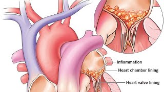 Infective Endocarditis [upl. by Damha]