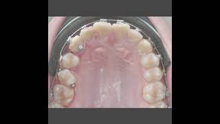 biomechanics orthodontist braces [upl. by Hurwit]