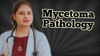 Mycetoma pathology  fungal infection  pathology lectures in hindi [upl. by Kyre]