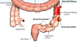 Diverticulitis [upl. by Maryl]