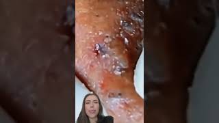 Blackheads Removal  Acne Treatment and Very Satisfying Satisfying Pimple pop blackheads [upl. by Yup]