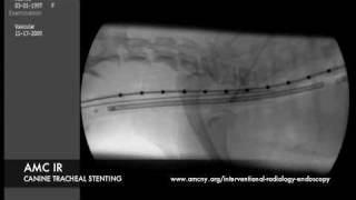 Interventional Radiology Tracheal Stent [upl. by Kyl781]