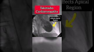 Myocardial Infarction due to Stress Takotsubo cardiomyopathy heart stress shorts shortsvideo [upl. by Baptlsta912]