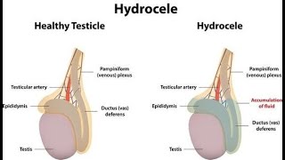 Soothing the Swell Natural Remedies for Hydrocele [upl. by Old508]