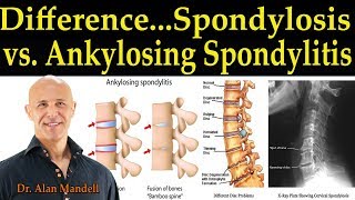 The Difference Between Spondylosis amp Ankylosing Spondylitis  Dr Alan Mandell DC [upl. by Nissie]