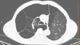 emphysema ct [upl. by Notserk]