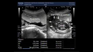 Ultrasound Video showing Hydrops fetalis fetal hydrops [upl. by Nnael]