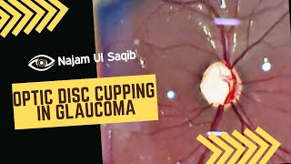 Optic Disc Cupping In Glaucoma Glaucomatous Optic Nerve Damage [upl. by Nyleak]