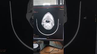 CT SCAN OF BRAIN ANGIOGRAPHYmedical shortfeedsviralmillion 1000subscriberctscan angiography [upl. by Enaid]