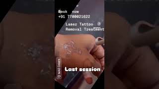 madinkers lasertattooremovalspecialist tattooremoval tattooremovalspecialist tattoo [upl. by Little252]