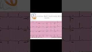 Cómo Identificar el Síndrome de WPW en un Electrocardiograma  Dr José Mario Porto [upl. by Gabie917]