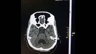 Leukoencephalopathy Mild obstructive hydrocephalus Mild cerebral atrophy [upl. by Airdua161]