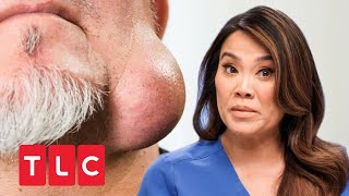 Riesige Beule am Kinn  Dr Pimple Popper  TLC Deutschland [upl. by Eelrahs]