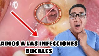 ¿COMO PUEDES PREVENIR LA ALVEOLITISINFECCION DESPUES DE UNA EXTRACCION DENTAL [upl. by Carlstrom]