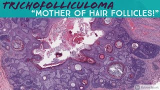 Trichofolliculoma 5Minute Pathology Pearls [upl. by Aniara]