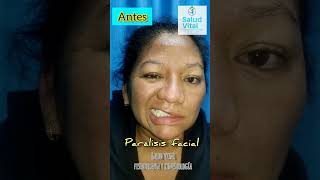 parálisis facial antes y después [upl. by Florenza]