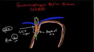 Pathophysiology of Gastroesophageal Reflux Disease GERD [upl. by Lise]