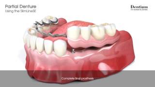 Partial denture [upl. by Airtal]