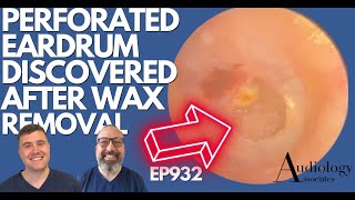 PERFORATED EARDRUM DISCOVERED AFTER EAR WAX REMOVAL  EP932 [upl. by Ecirad]